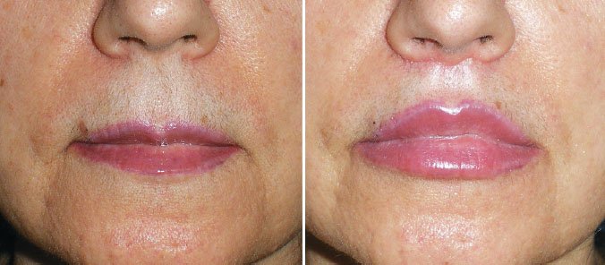 Lip lift.jpg